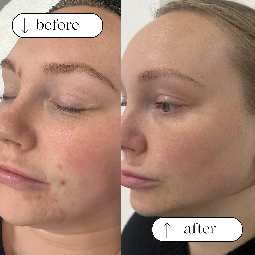 Before and after — real Dermaluxe client skin result
