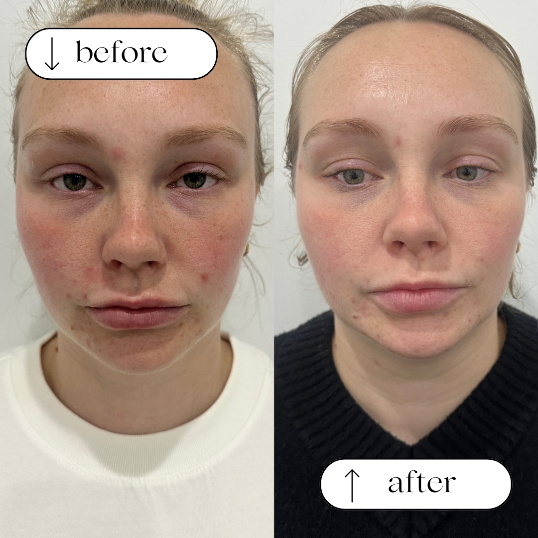 Before and after — real Dermaluxe client skin result
